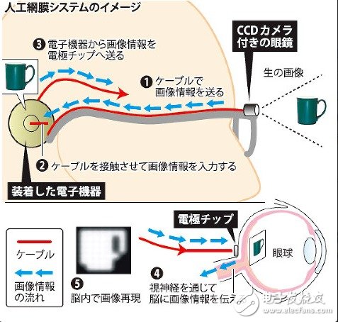 日本人工视网膜用电子芯片代替视网膜细胞发挥作用